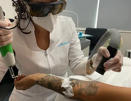 NZ Laser Tattoo Removal