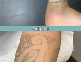 NZ Laser Tattoo Removal